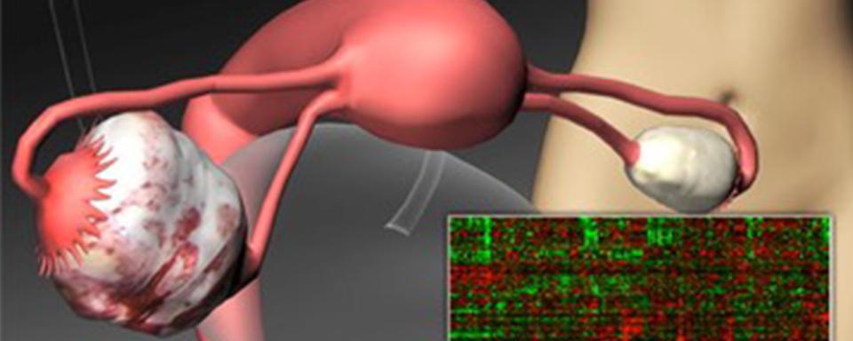 Ovarian Cancer DNA Image
