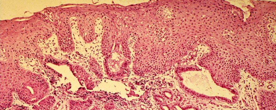 Cervical cancer image